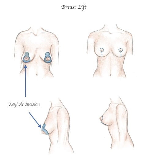 breast lift procedure