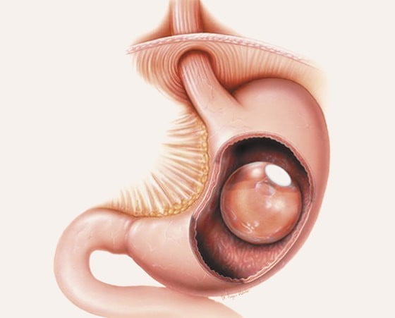 ORBERA gastric balloon