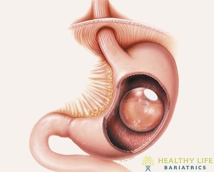 Gastric Balloon Procedure