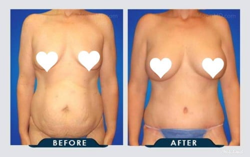 Smart Lipo