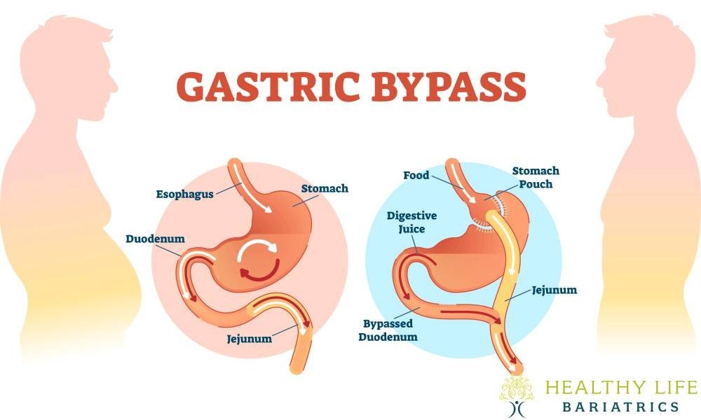 Gastric Bypass Weight Loss Surgery Los Angeles Healthy Life Bariatrics