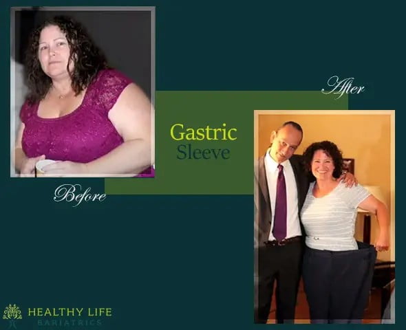Before and after gastric sleeve patient