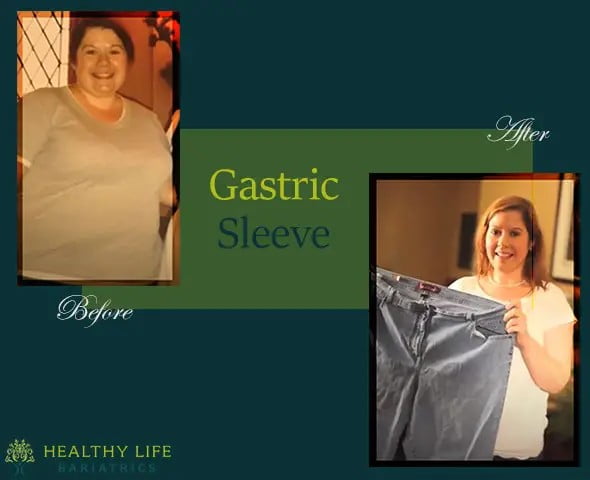 gastric sleeve surgery before and after- Los Angeles CA