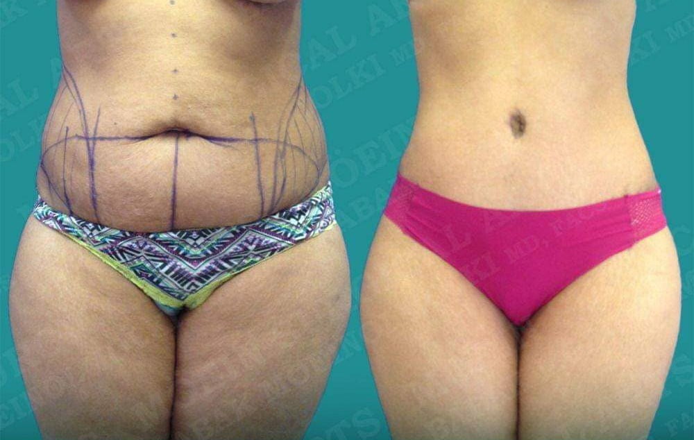 tummy tuck and liposuction- babek moeinolmolki
