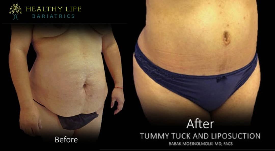 tummy tuck and liposuction