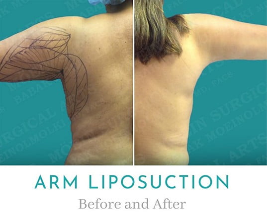 Arm Liposuction