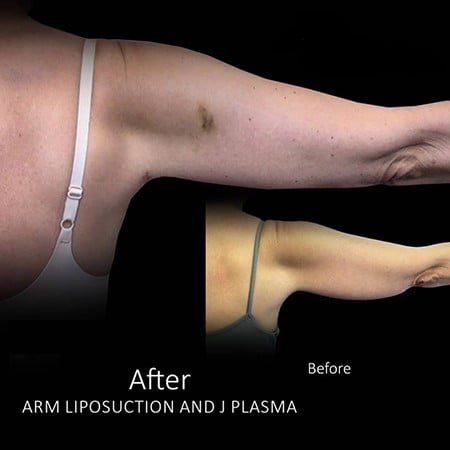 Arm Reduction, Arm Liposuction