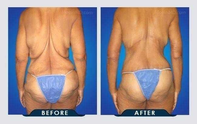 back and butt lift