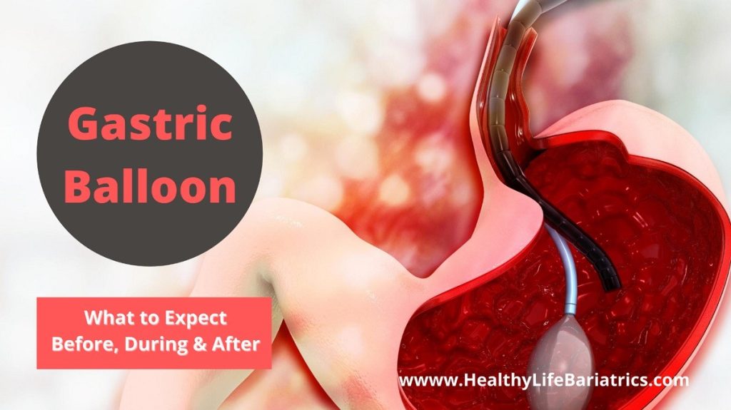 Gastric Balloon Preparation for Placement in Los Angeles CA HLB