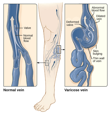Varicose vein spider vein treatment