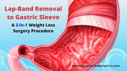 Lap Band Failed to Work? Ask About Transitioning from Lap Band Removal to Gastric Sleeve for 80% Excess Weight Loss!