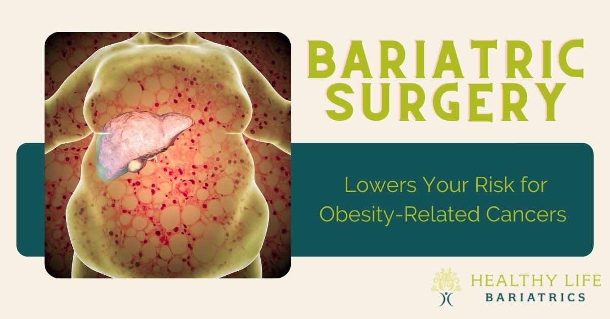 Cancer Risk Lowered for Obese People After Bariatric Surgery}
