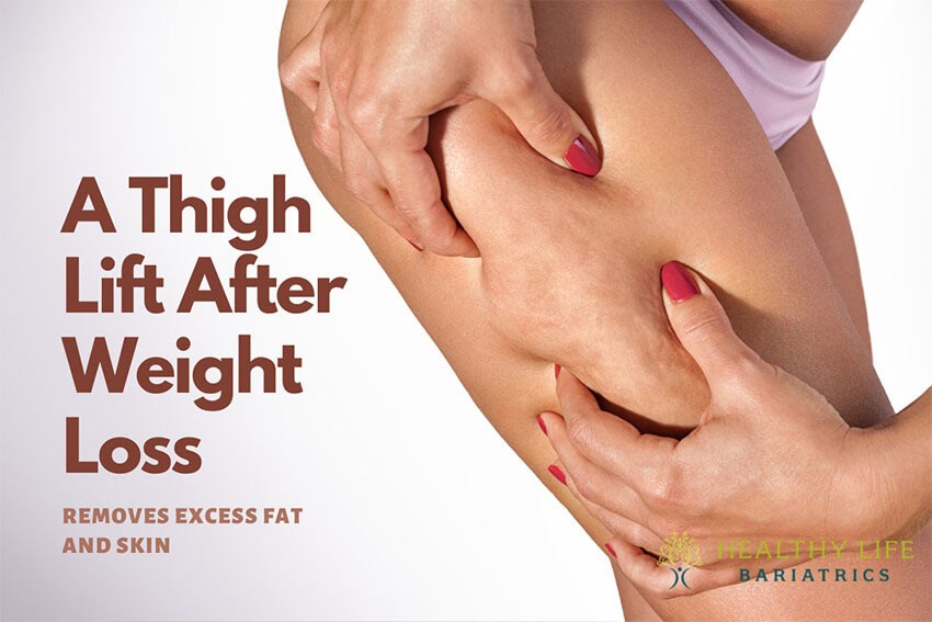 A Thigh Lift After Weight Loss Removes Excess Fat and Skin