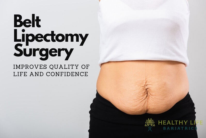 Belt Lipectomy Surgery to Remove Hanging Skin in LA