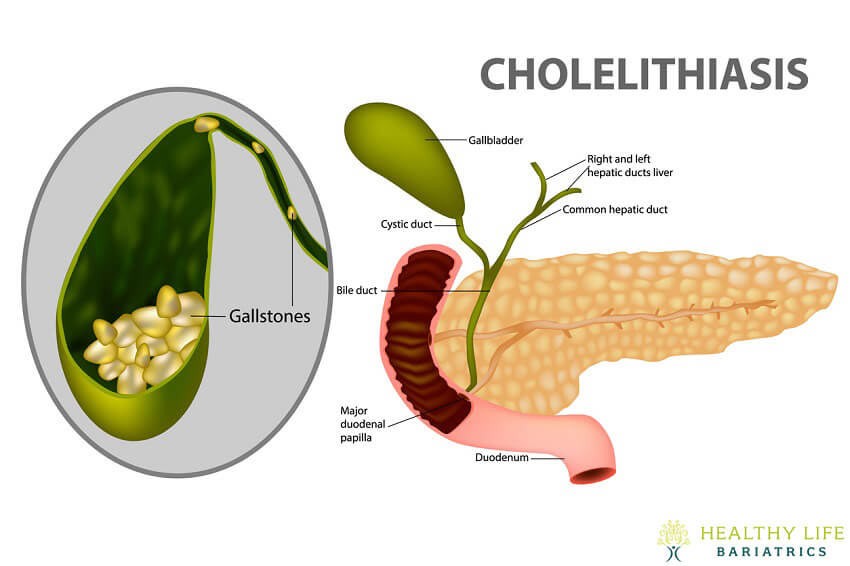 Certain Risk Factors for Gallstones