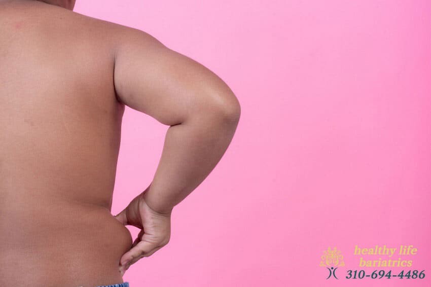New Acceptance Guidelines of Bariatric Surgery
